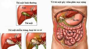 Viêm túi mật - Hình ảnh minh họa